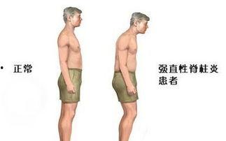 强直性脊柱炎的明星,勇敢面对，无畏前行